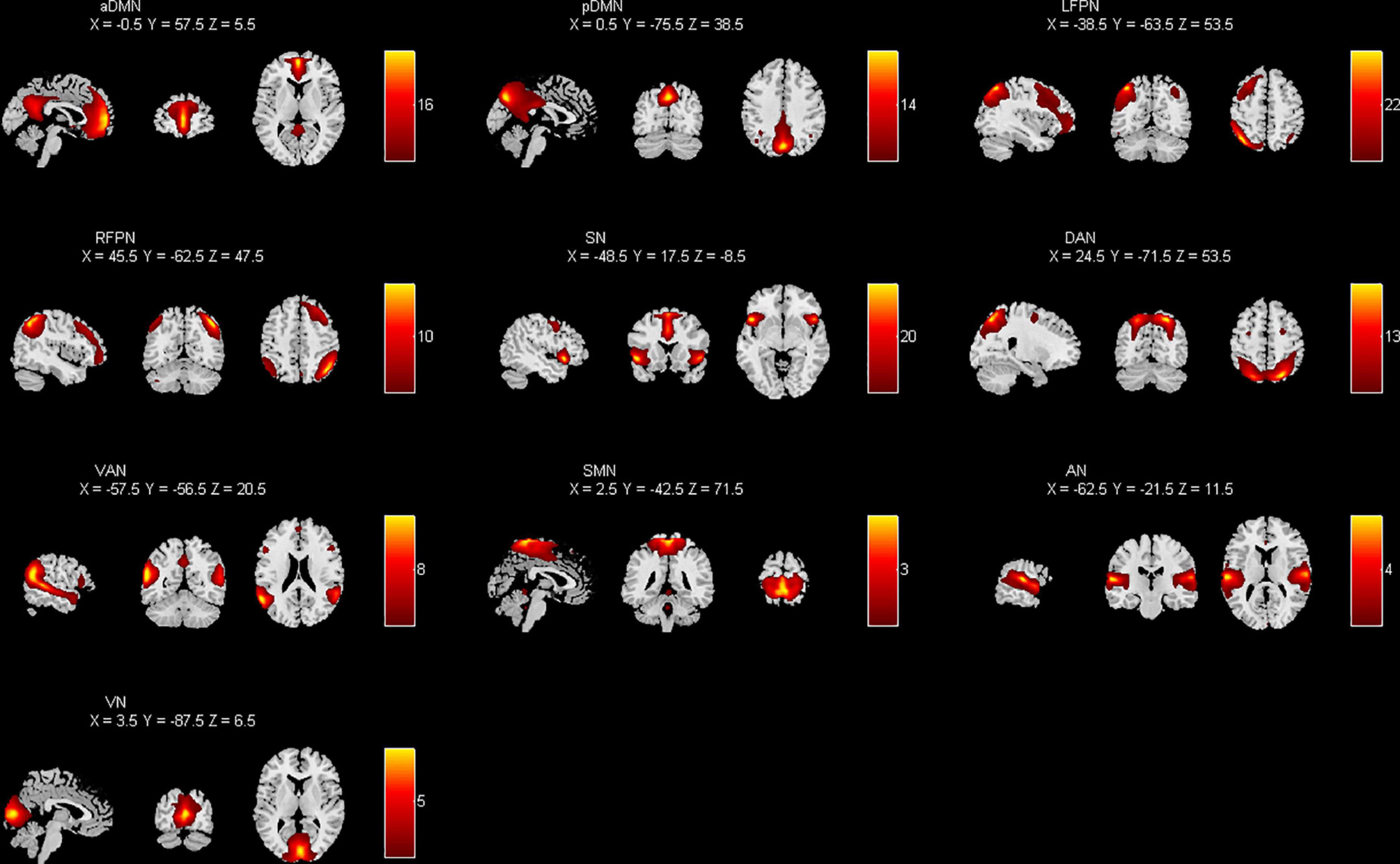 Study of brain network alternations in non-lesional epilepsy patients by BOLD-fMRI